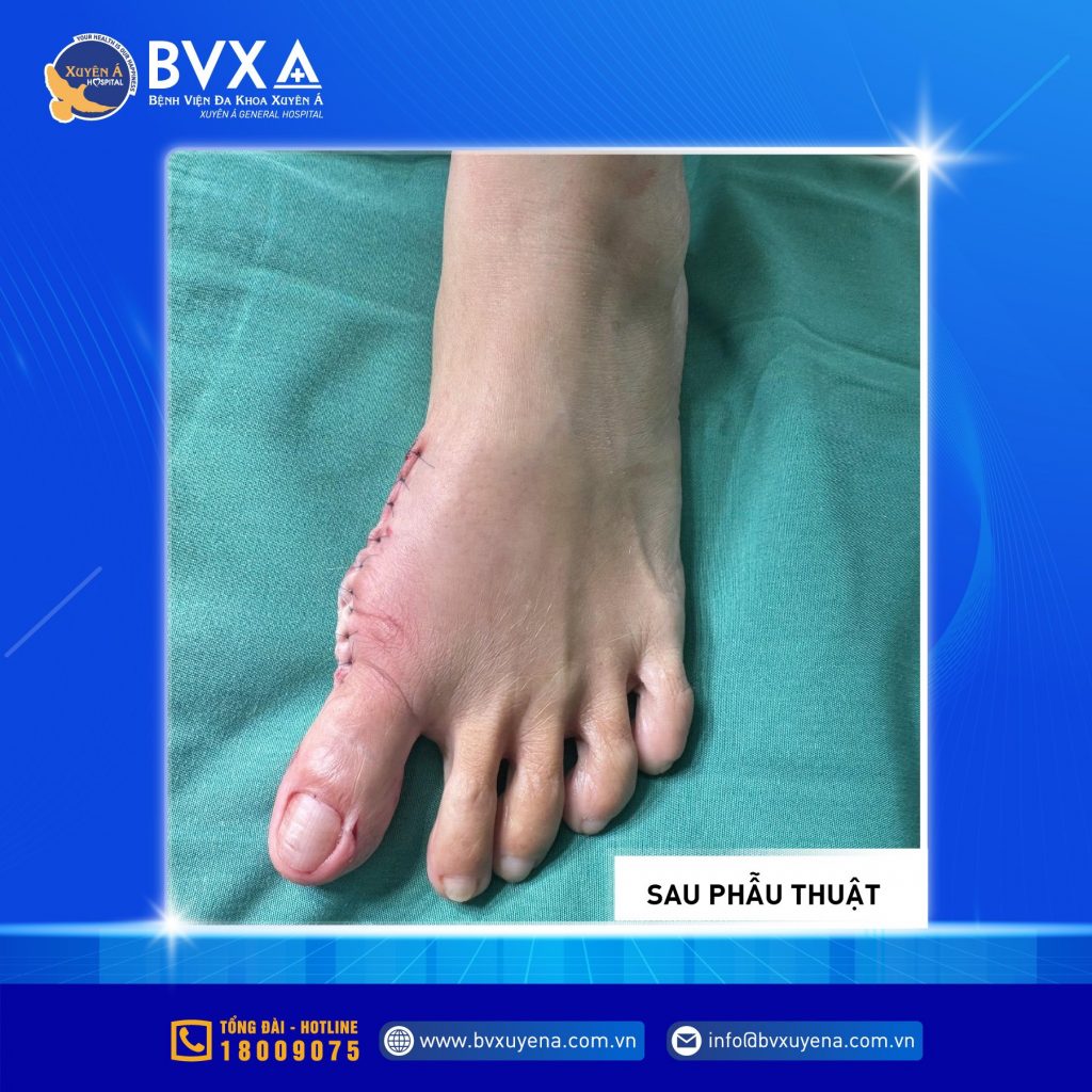 Hình ảnh ngón chân vẹo sau khi phẫu thuật