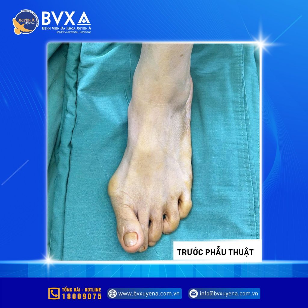 Hình ảnh ngón chân vẹo trước khi phẫu thuật
