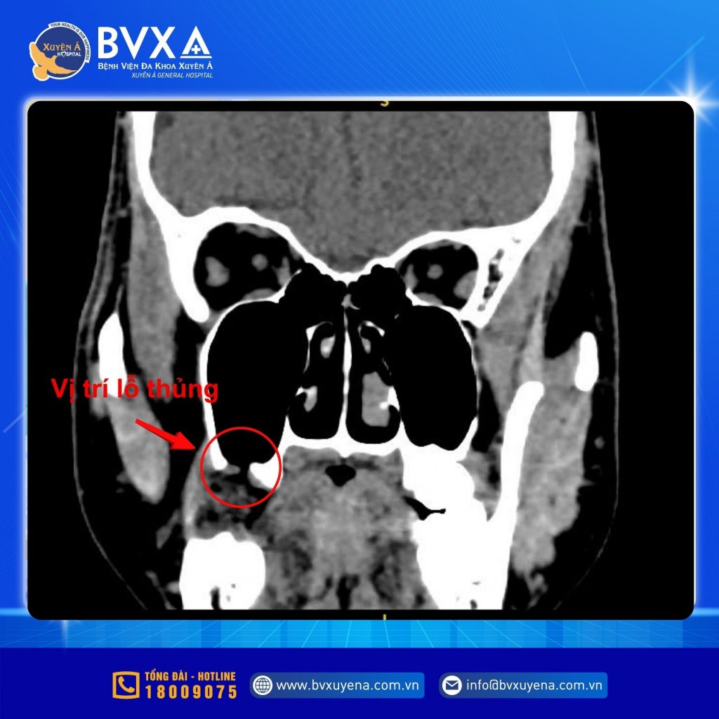Hình ảnh CT cho thấy bệnh nhân thủng xoang hàm sau khi nhổ răng khôn