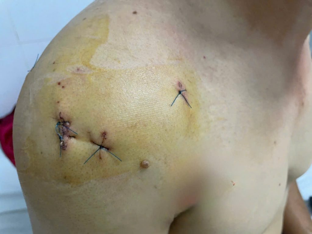 Hình ảnh vết khâu sau khi thực hiện nội soi khớp vai