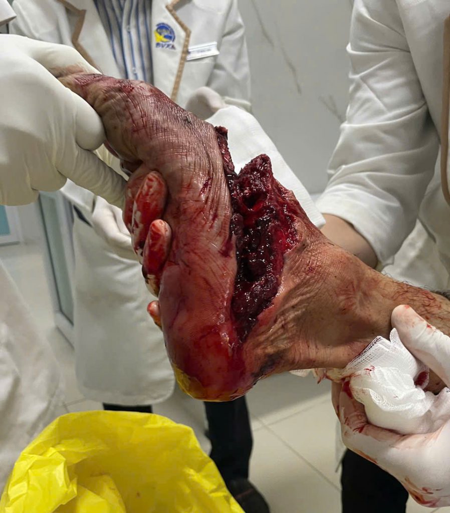 Hình ảnh bàn chân đứt lìa