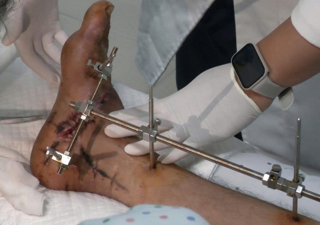 Hình ảnh bàn chân đứt lìa sau phẫu thuật nối chi