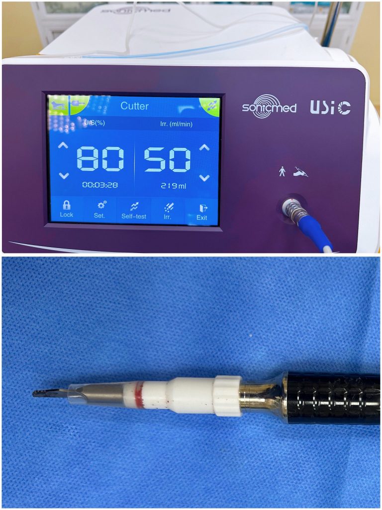 Hình ảnh dao siêu âm cắt xương