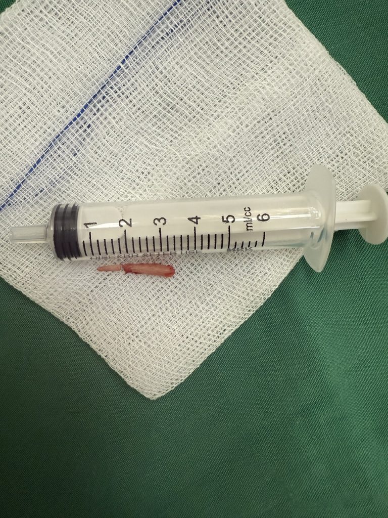 Hình ảnh đoạn xương mỏm trân sau khi cắt bỏ