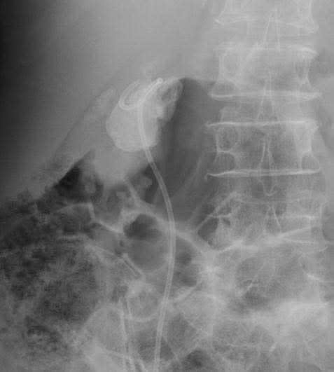 Hình ảnh CT cho thấy sỏi san hô bên trong thận