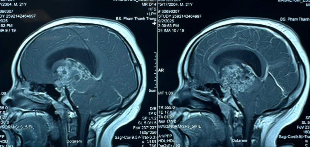 Hình ảnh MRI khối u sọ hầu