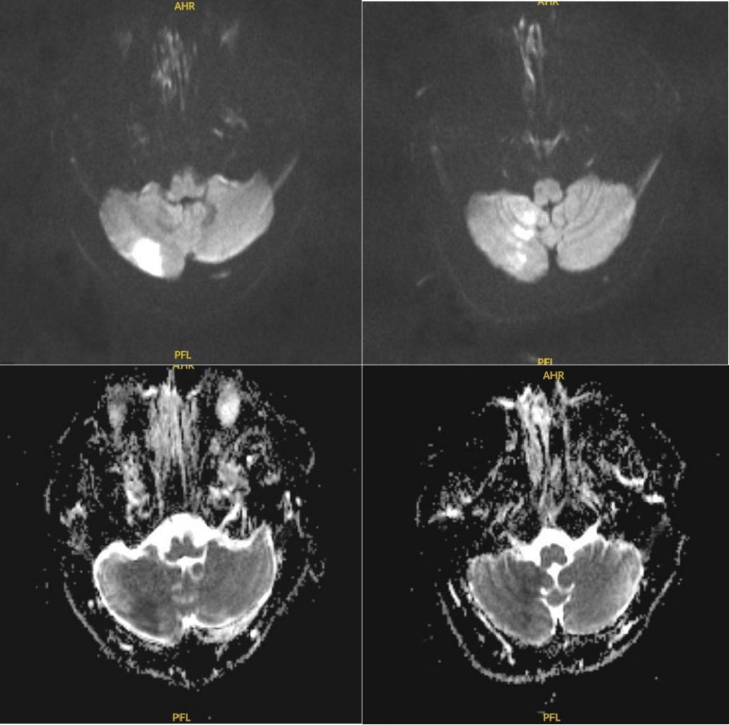 Hình chụp MRI của bệnh nhân trong khi đá banh bị đột quỵ