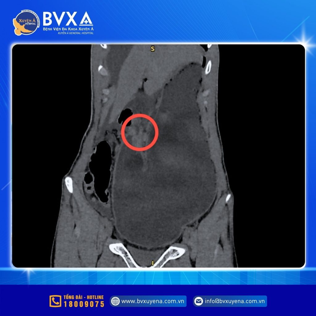 Hình ảnh CT cho thấy bệnh nhân bị thủng ổ loét môn vị tá tràng