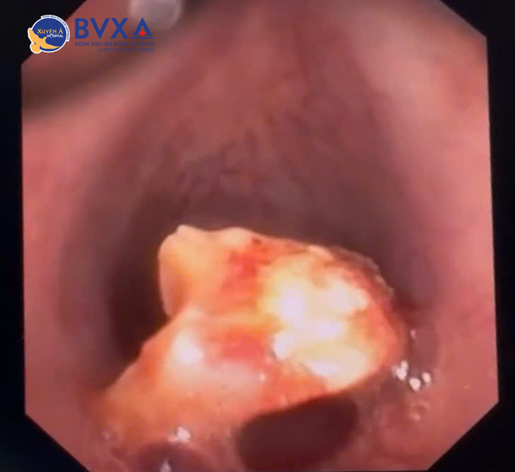 Hình ảnh mảnh xương cá được tìm thấy trong phế quản gốc trái