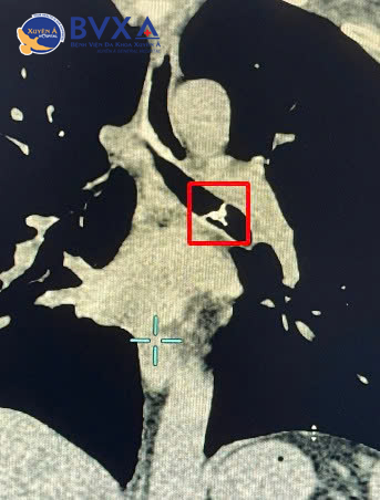 Hình ảnh CT cho thấy mảnh xương cá