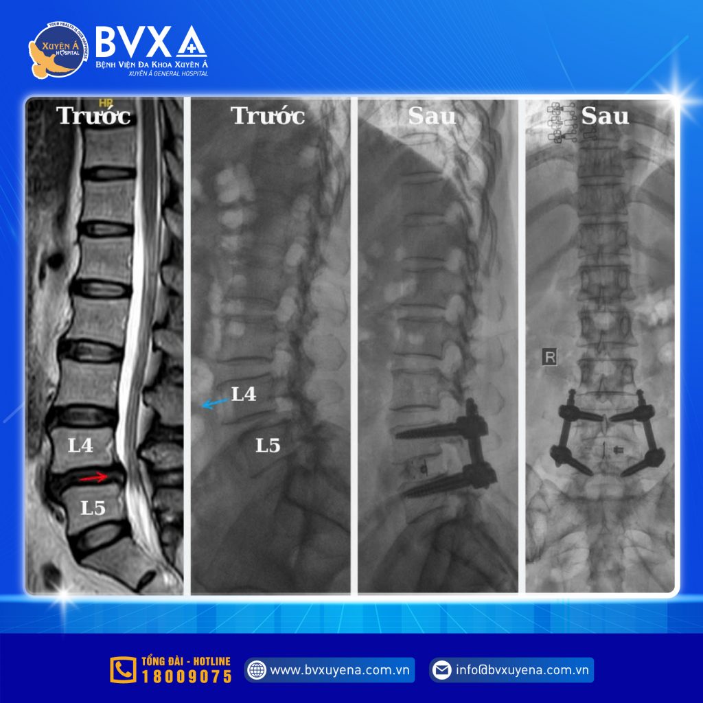 Hình ảnh cận lâm sàng trước và sau của bệnh nhân thoát vị đĩa đệm
