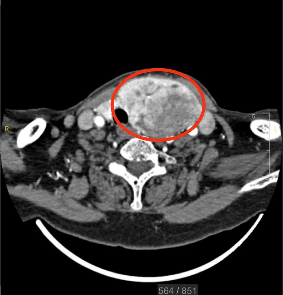 Hình ảnh CT cho thấy khối bướu giáp