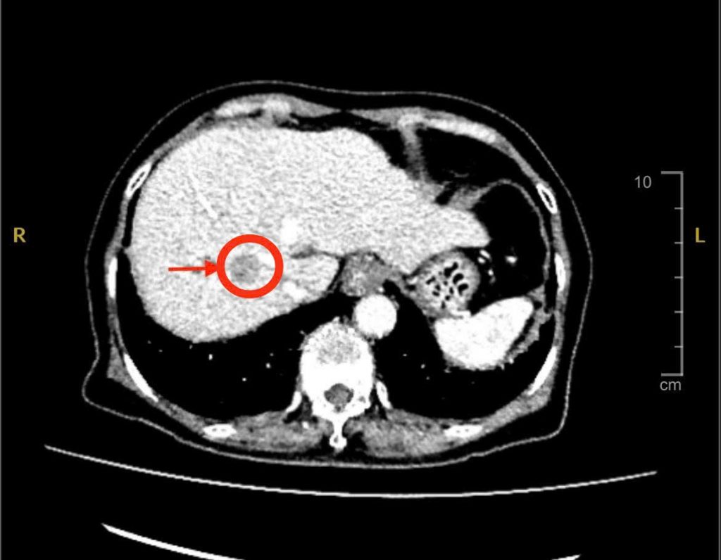 Hình ảnh CT khối u gan