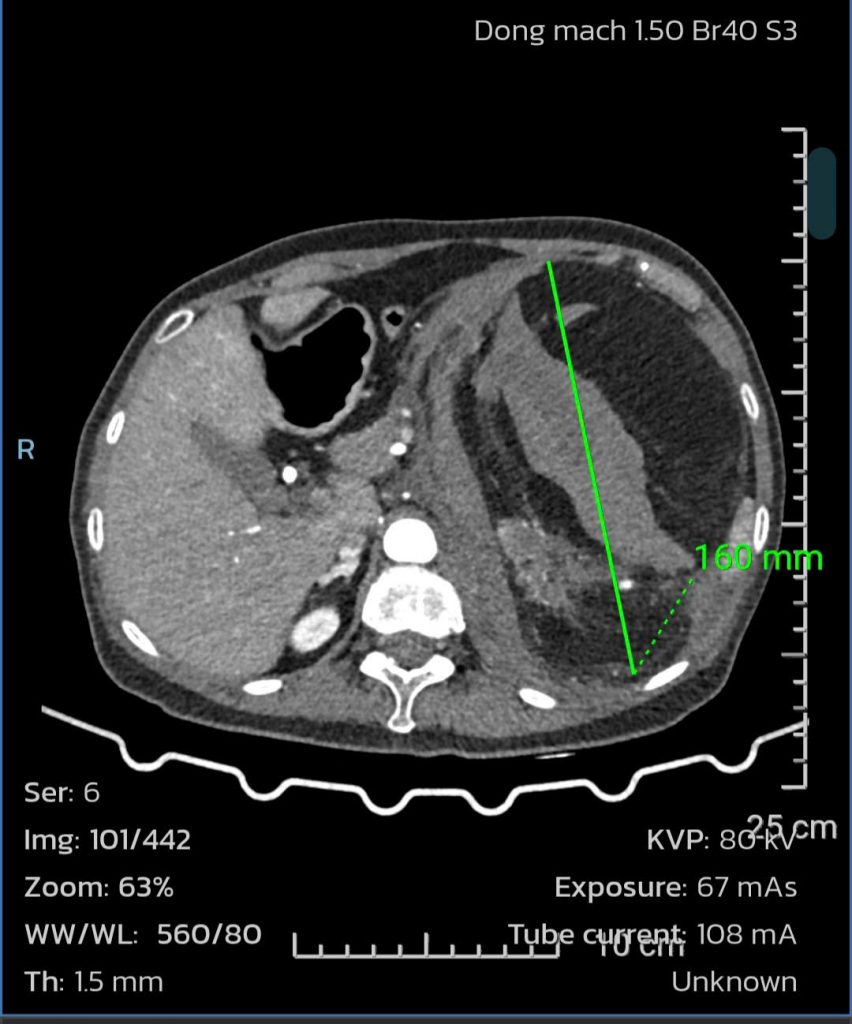 Hình ảnh CT scan