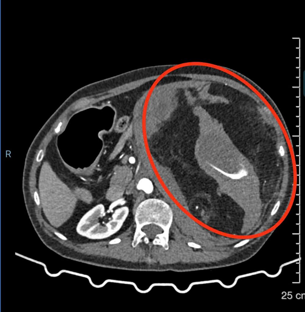 Hình ảnh CT scan khối bướu thận gây xuất huyết