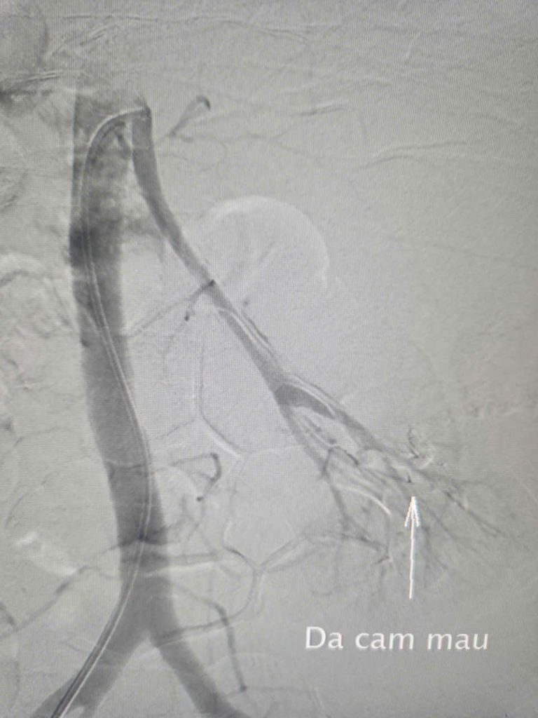 Hình ảnh mạch máu sau can thiệp tắc mạch