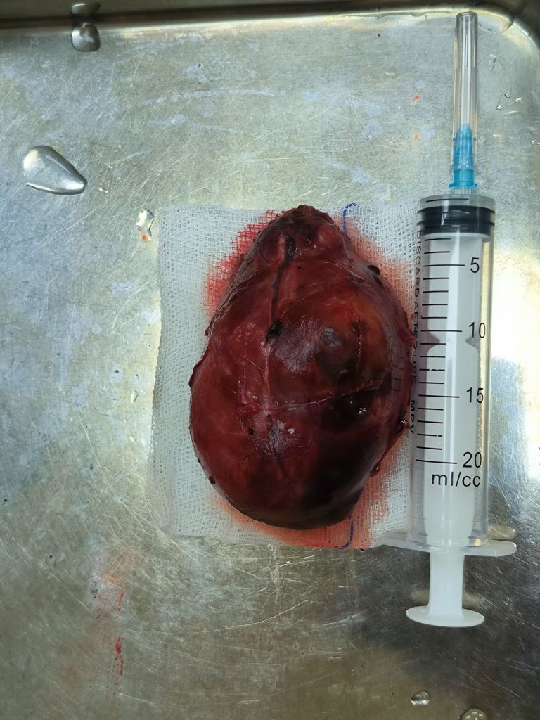 Khối bướu giáp lớn được lấy ra