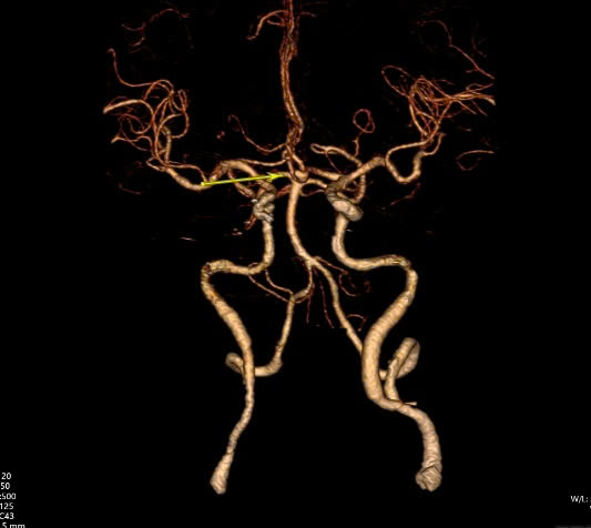 Vị trí túi phình mạch máu não