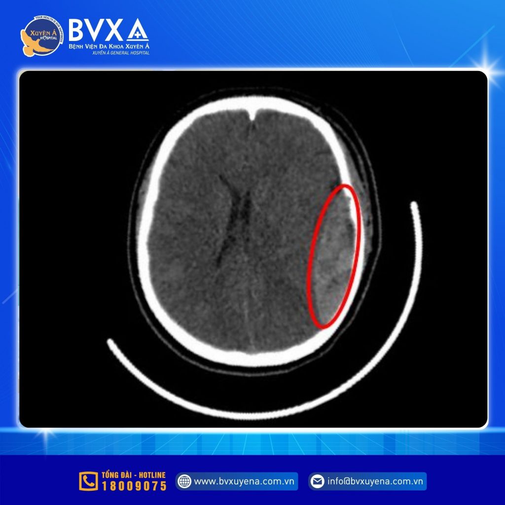 Hình ảnh MRI não của nữ sinh 15 tuổi gặp tai nạn vì tà áo dài cuốn vào bành xe