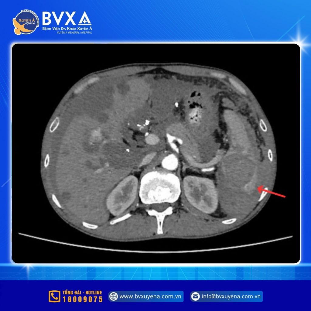 Hình ảnh MSCT cho thấy vỡ lách độ IV