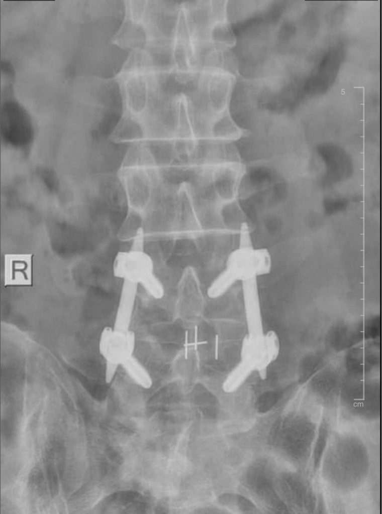 Hình ảnh MRI của bệnh nhân thực hiện bắt vít qua da