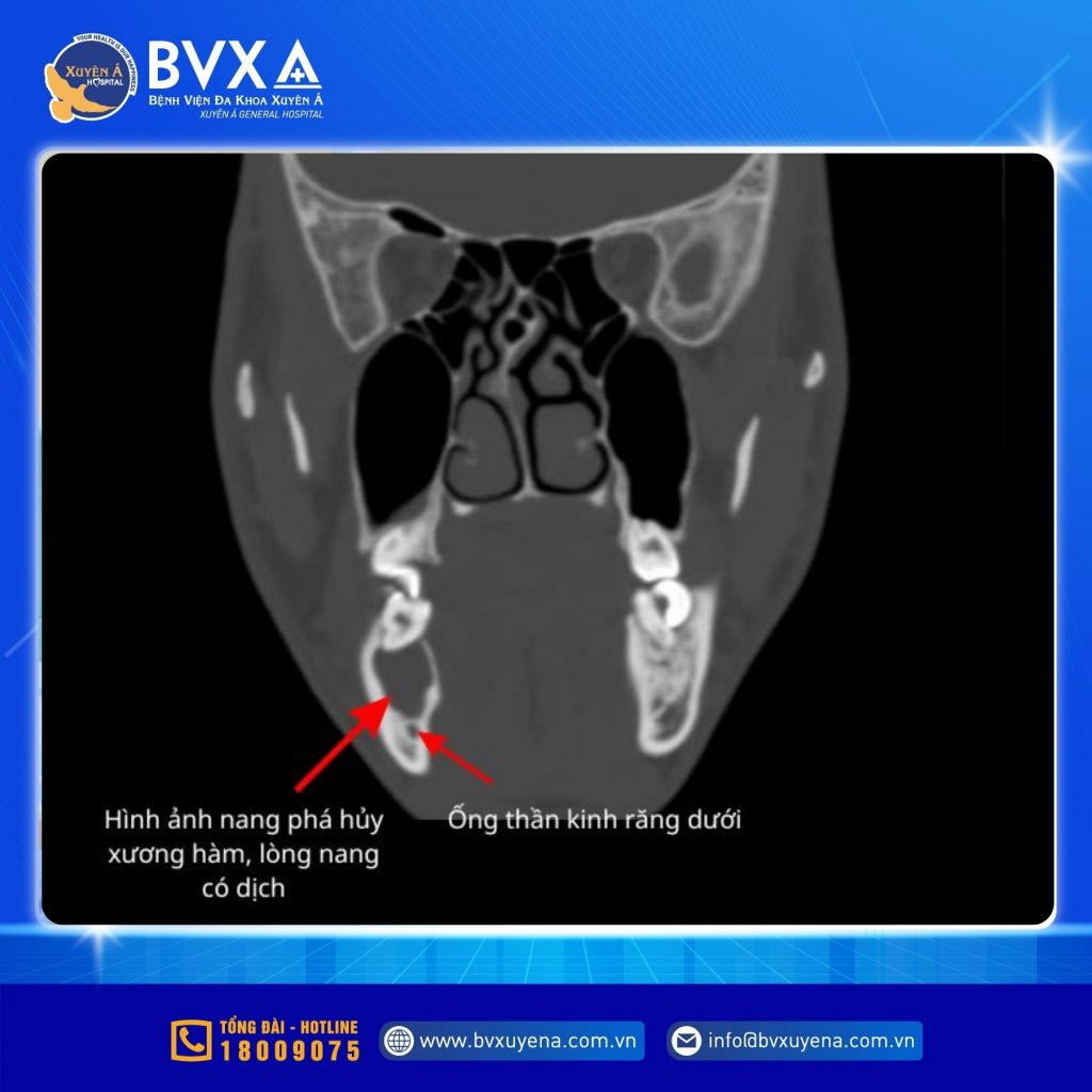 Hình ảnh răng sâu dẫn đến nang lớn kèm phá hủy xương hàm dưới