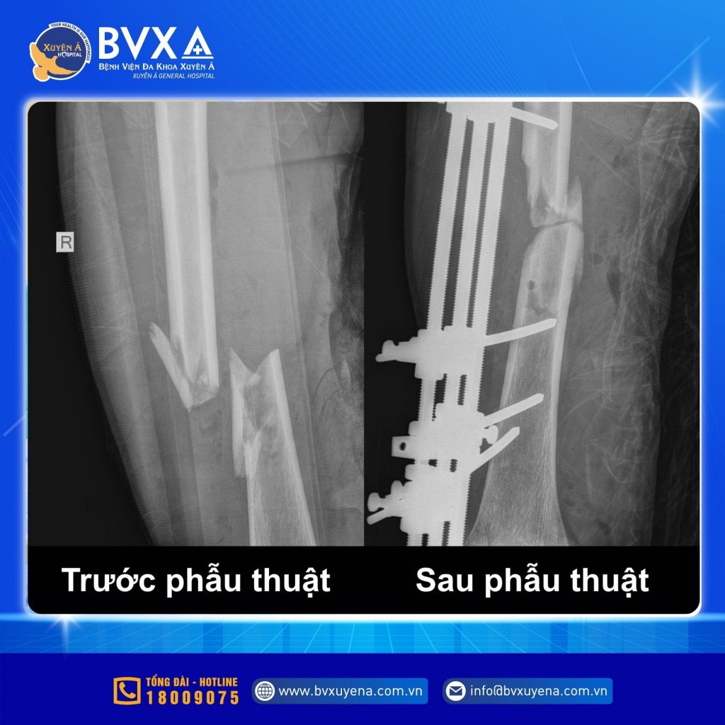 Hình ảnh X-quang trước và sau phẫu thuật