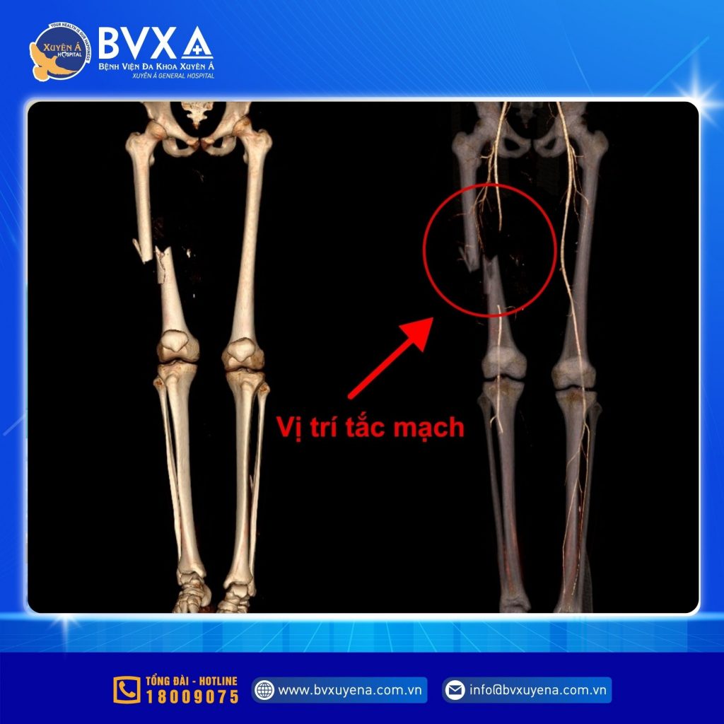 Hình ảnh cận lâm sàng cho thấy phan xương gãy