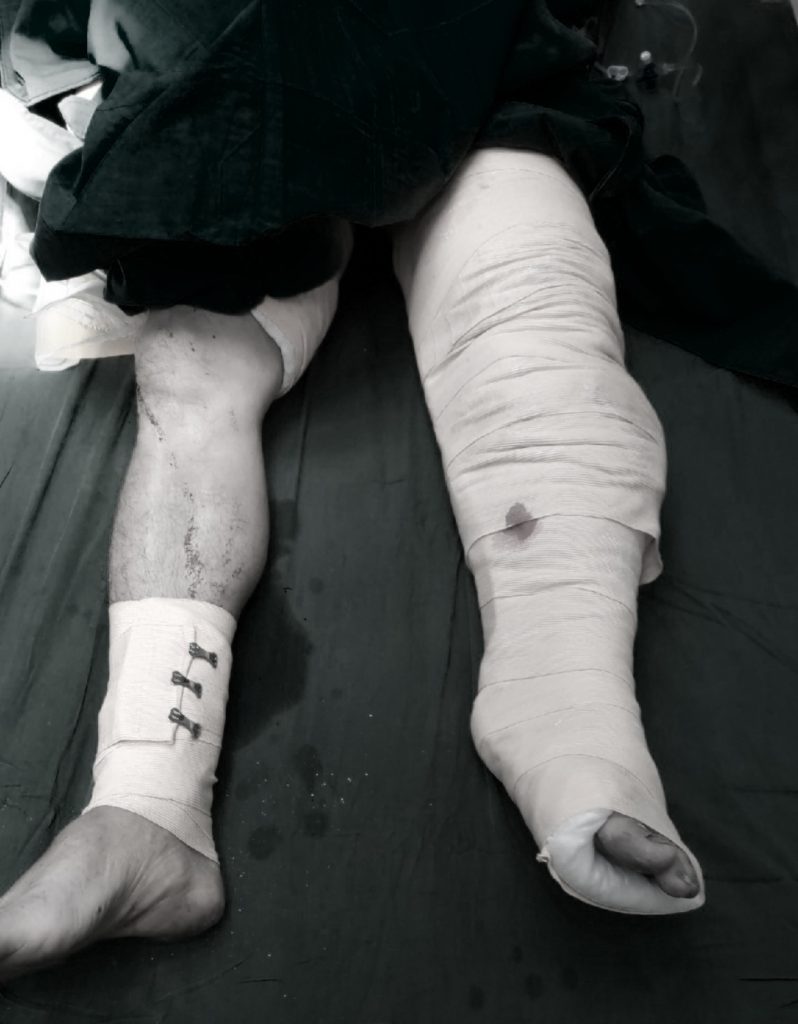 Hình ảnh cẳng chân bệnh nhân sau khi được thực hiện phẫu thuật nối chi