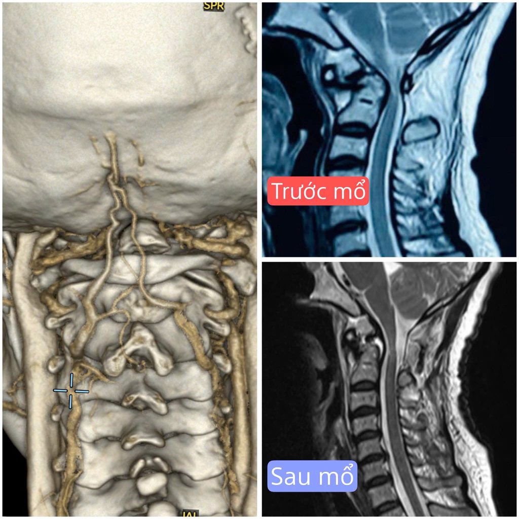 Hình ảnh MRI trước vào sau phẫu thuật trượt đốt sống cổ