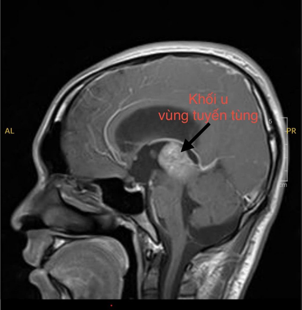 Hình ảnh MRI khối u vùng tuyến tùng