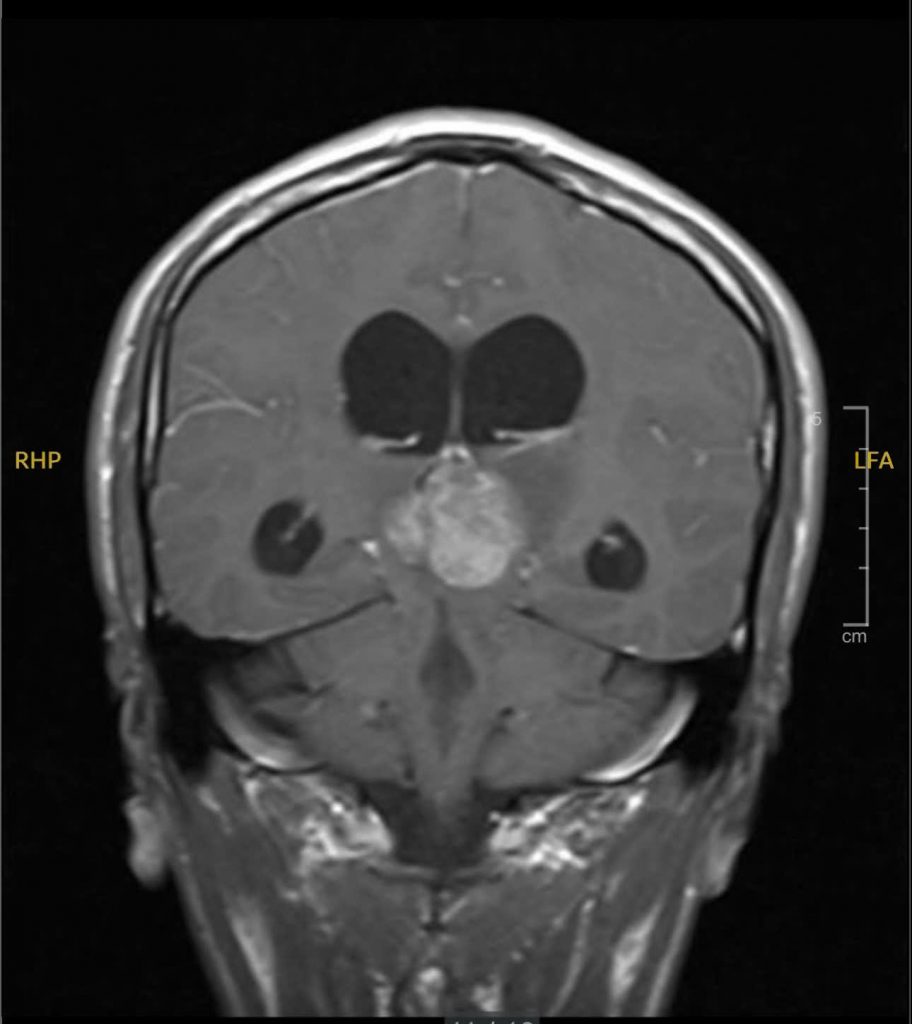 Hình ảnh MRI khối u vùng tuyến tùng