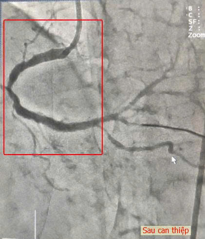 Hình ảnh sau can thiệp đặt stent