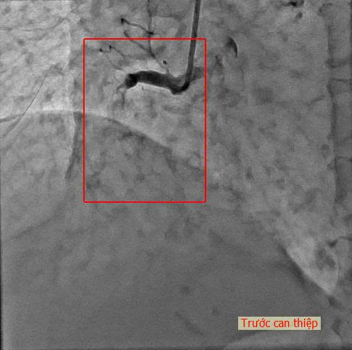 Hình ảnh ekip can thiệp tại phòng DSA