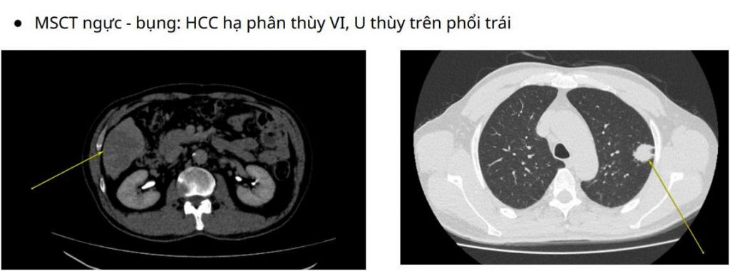 Hình ảnh phim CT của bệnh nhân Campuchia