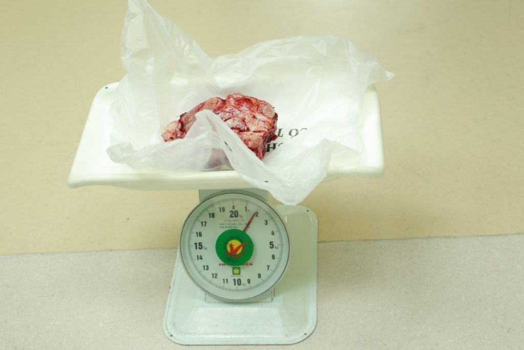 Khối u vú được lấy ra sau mổ nặng 2kg