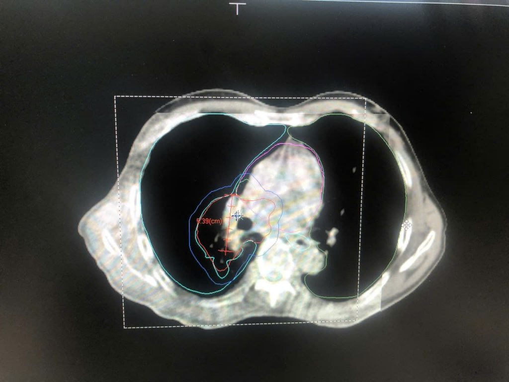 Hình ảnh cận lâm sàng cho thấy khối ung teo nhỏ sau 5 buổi điều trị