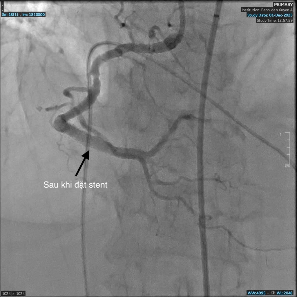 Mạch máu sau khi đặt stent