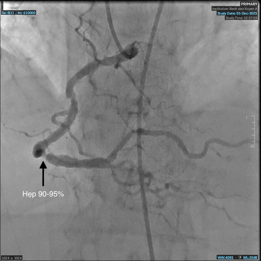 Mạch máu trước can thiệp hẹp đến 95_