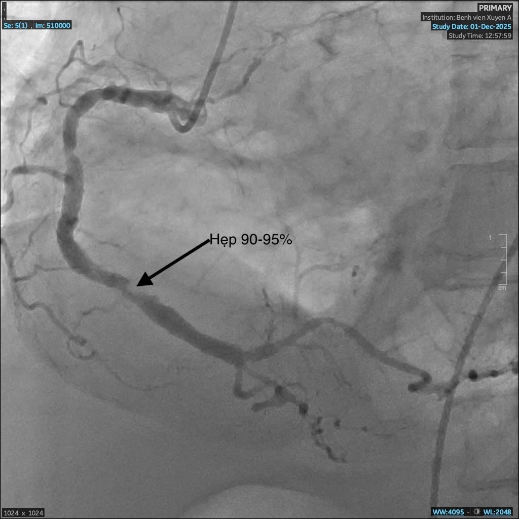 Mạch máu trước can thiệp