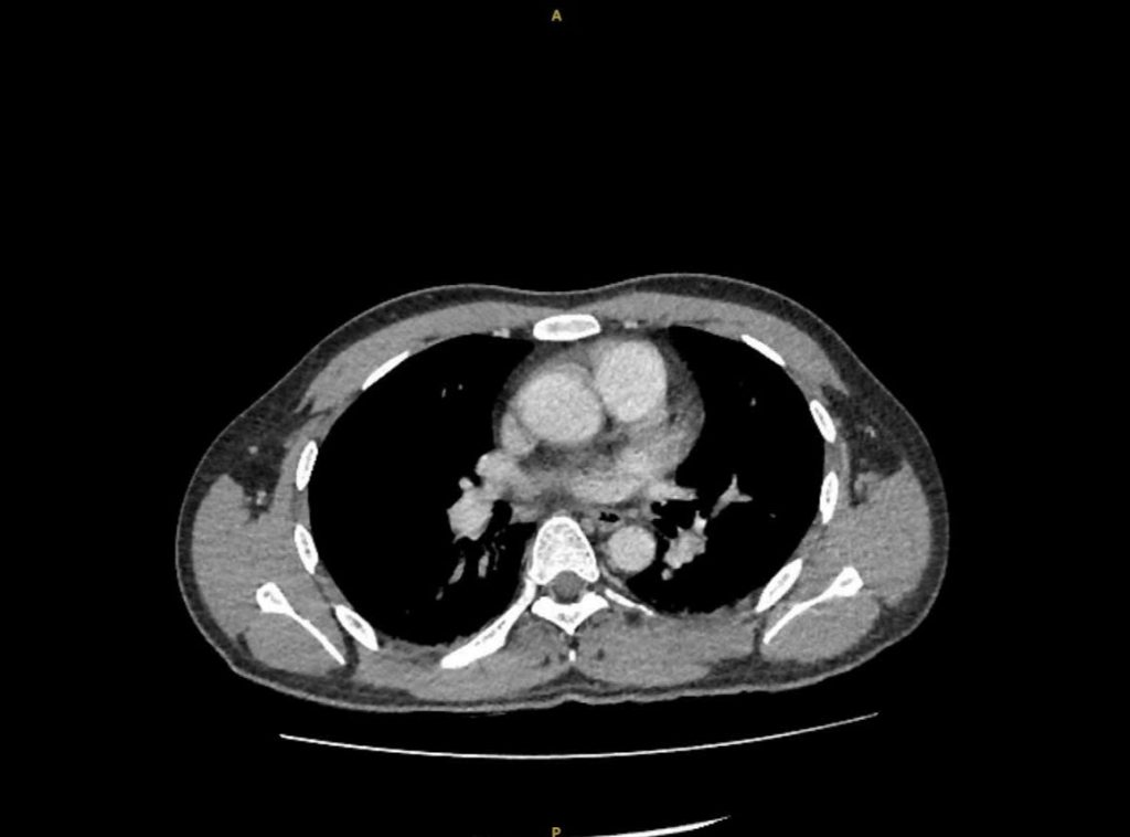 Hình ảnh phim CT trước mổ cho thấy thận có sỏi niệu quản bị ứ nước