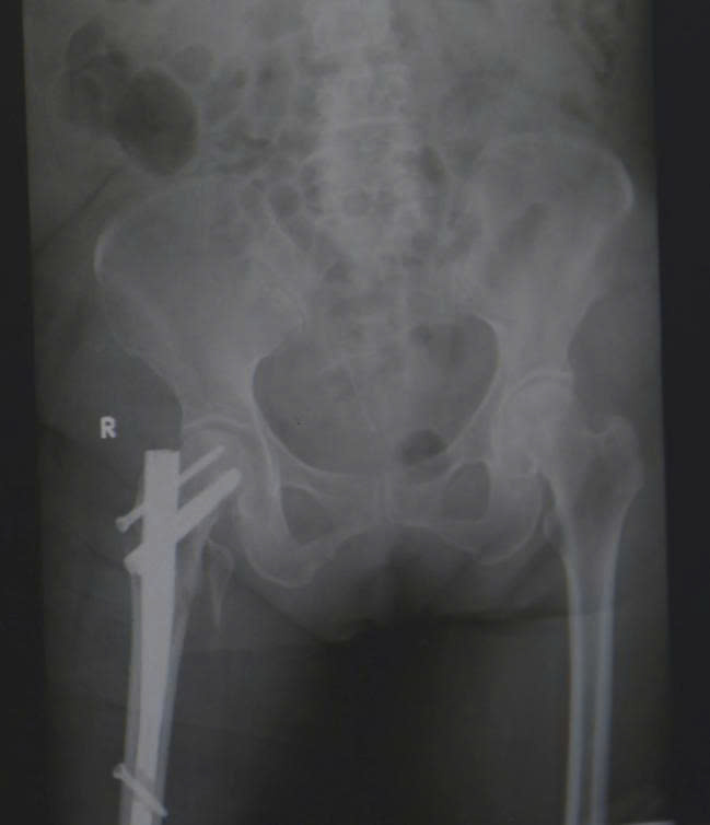 Hình ảnh phim X-quang sau phẫu thuật đóng đinh nối tụy cho bệnh nhân gãy liên mấu chuyển xương đùi
