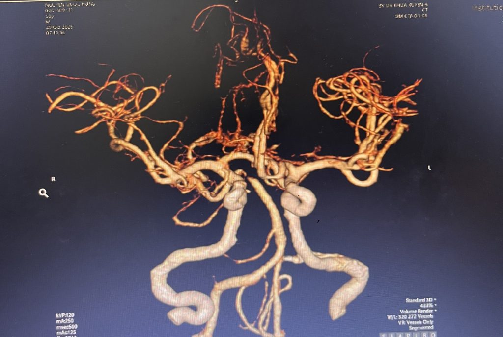 Hình ảnh phim CTA của bệnh nhân bị "đột quỵ thức giấc"