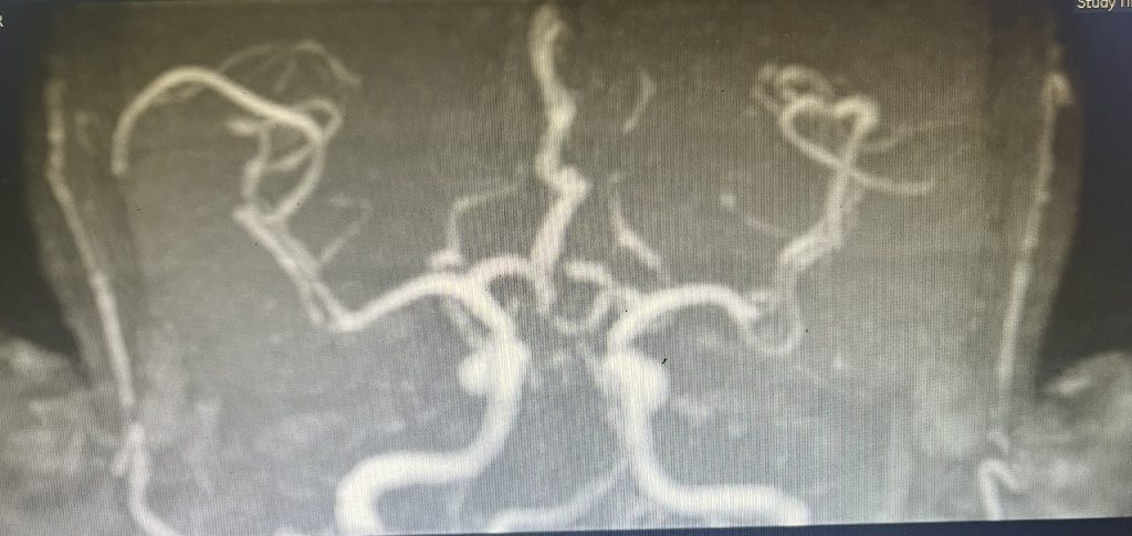 Hình ảnh phim MRI của bệnh nhân bị "đột quỵ thức giấc"