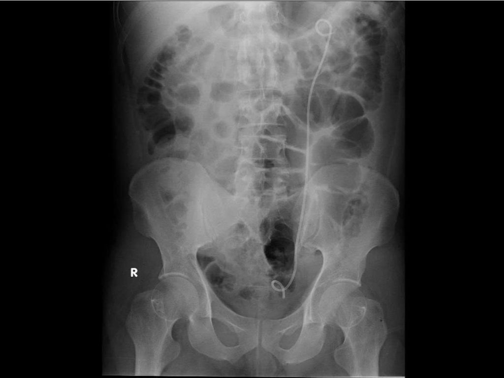 Hình ảnh cận lâm sàng sau khi đặt Sonde JJ dẫn lưu