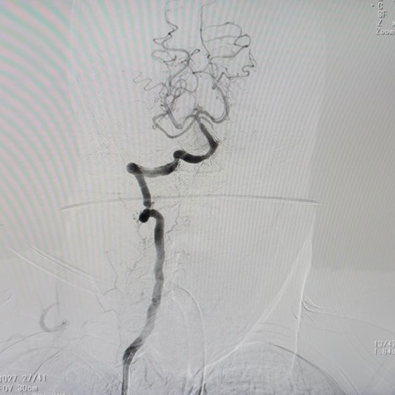 Sau khi can thiệp nội mạch