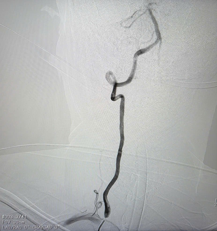 Sau khi tiêm thuốc tiêu sợi huyết (rTPA)