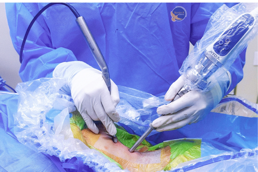 Hình ảnh thao tác phẫu thuật nội soi thoát vị đĩa đệm