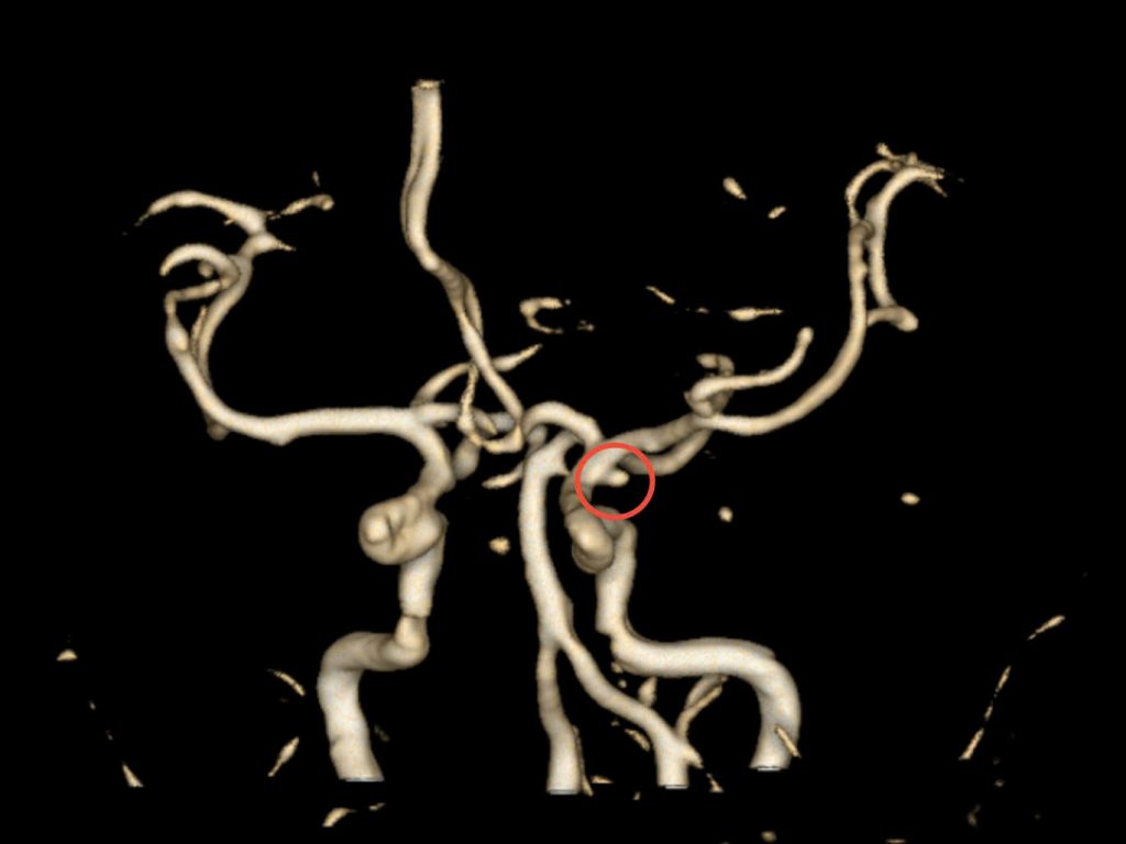 Vị trí túi phình trên phim CTA