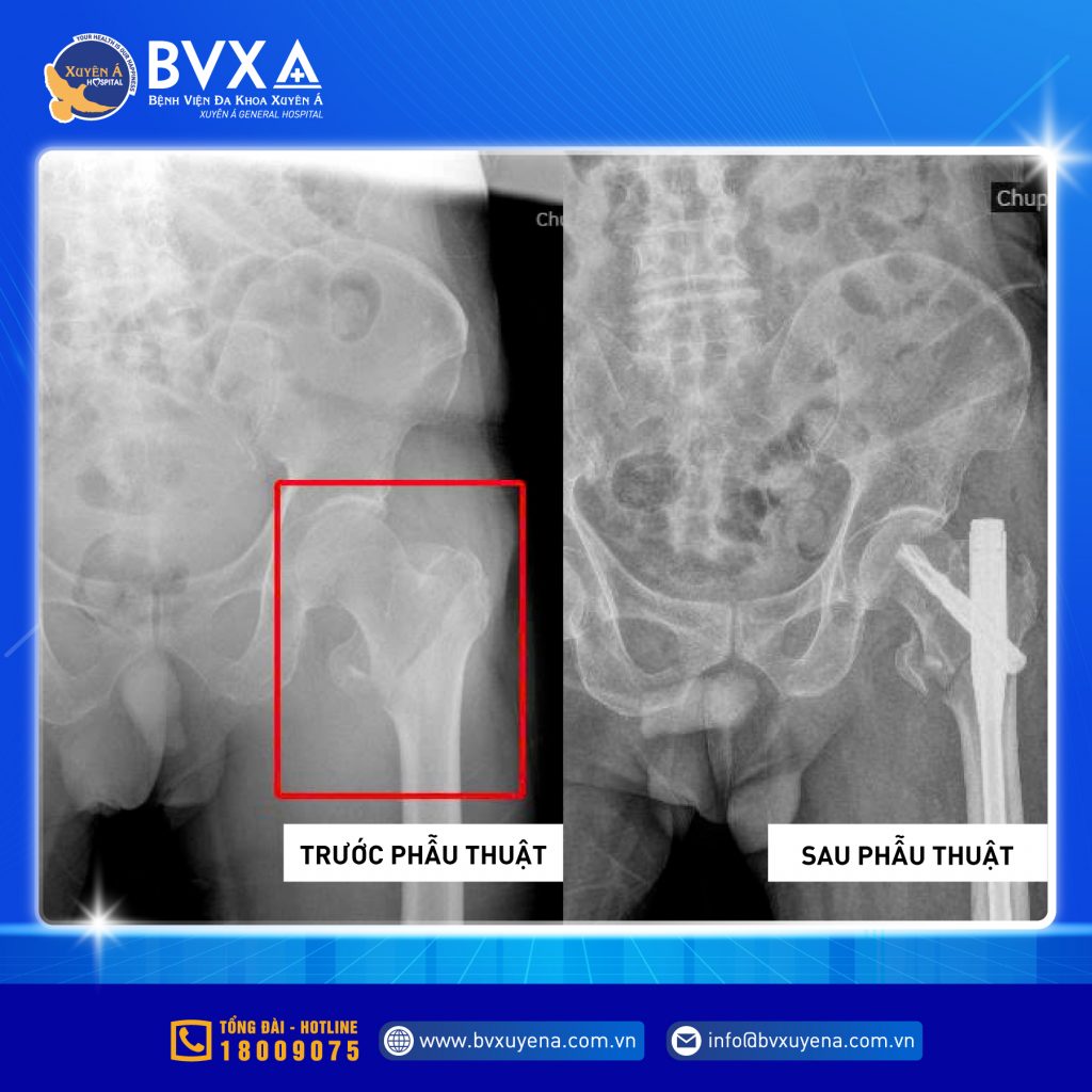 Hình ảnh cận lâm sàng trước và sau phẫu thuật đóng đinh nội tủy